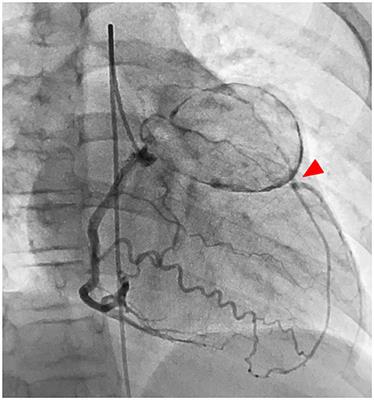 Coronary Revascularization of Giant Aneurysms in Children With Kawasaki Disease: A Report of Two Cases